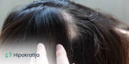 Alopecija - simptomi, vrste i opcije lečenja