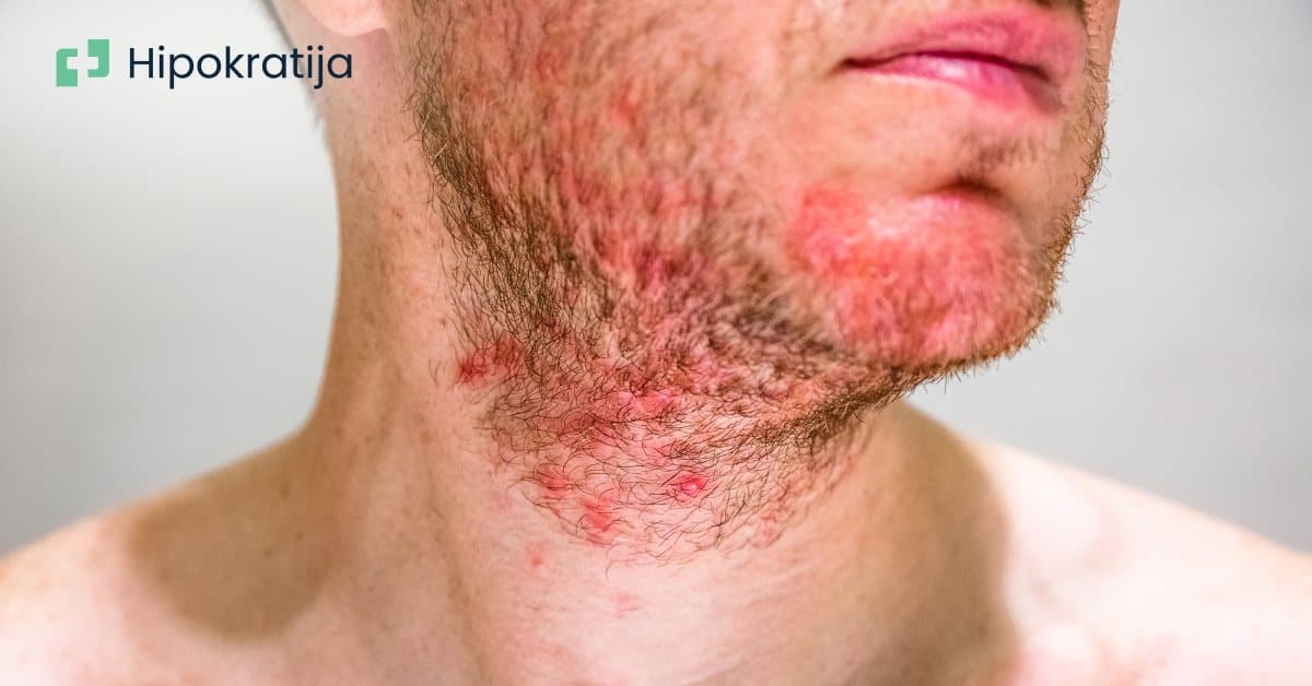 Cover Image for Seboroični dermatitis: Uzroci, simptomi i efikasni načini lečenja