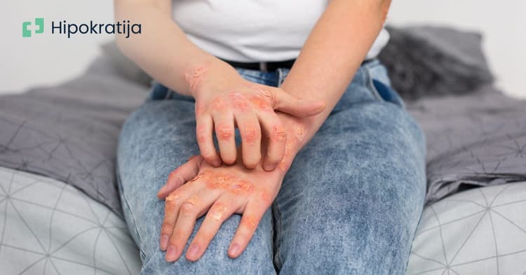 Šuga: Kako prepoznati, lečiti i sprečiti ponavljanje