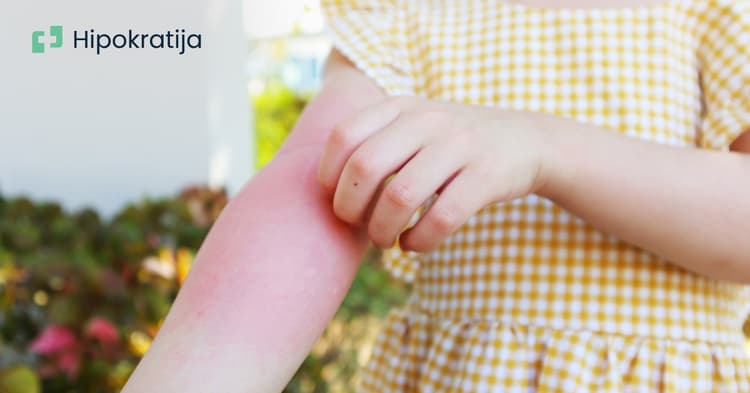 Ekcem kod beba i dece: Kako se nositi sa atopijskim dermatitisom u ranom uzrastu?