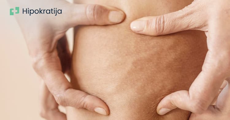 kako-se-resiti-celulita