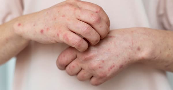 Cover Image for Rubeola: sve što treba da znate o ovoj zaraznoj bolesti