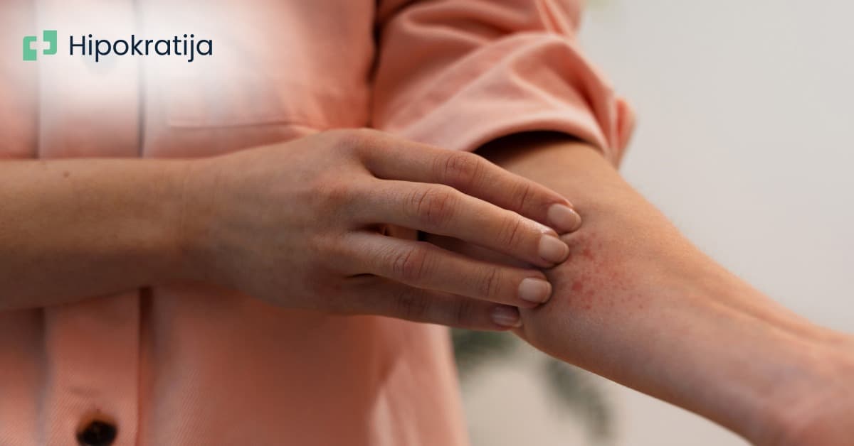 Cover Image for Boginje (varičele) kod odraslih: sve što bi trebalo da znate o ovom oboljenju