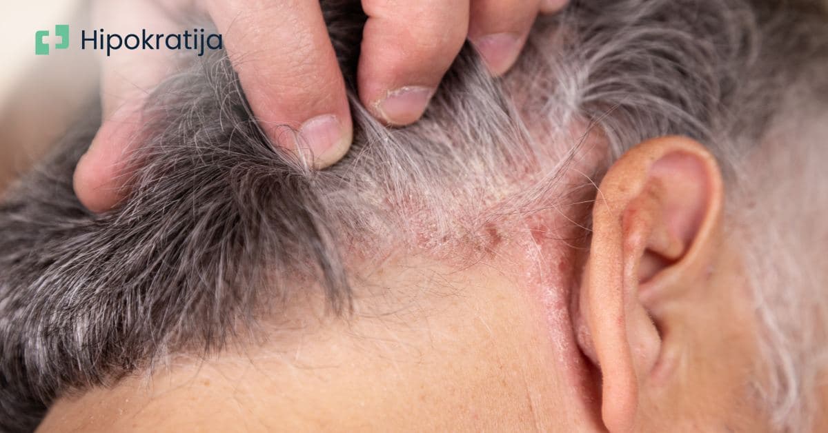 Cover Image for Psorijaza: Uzroci, simptomi i najefikasniji saveti