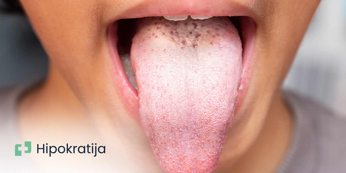 Cover Image for Kandida infekcija- simptomi, uzroci i lečenje