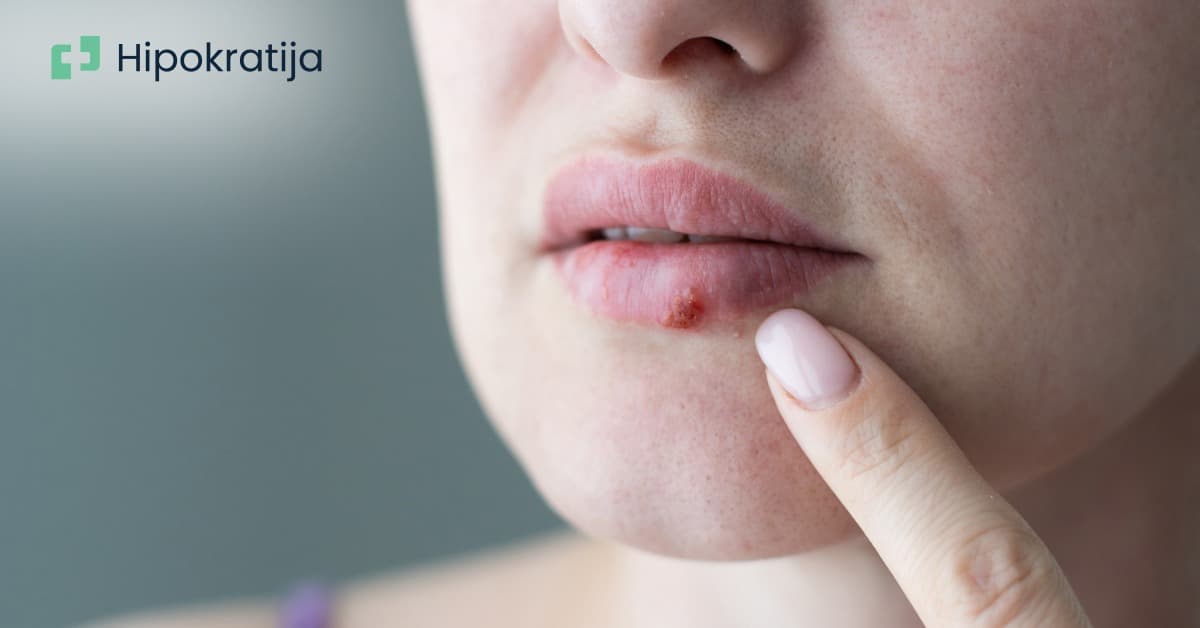 Cover Image for Sve o herpesu: Vrste, simptomi i kako sprečiti ponovna izbijanja